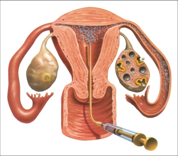 Intra-uterine insemination-1