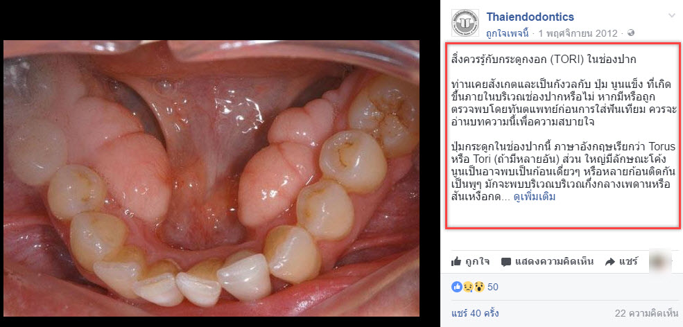 กระดูกงอก (TORI) ในช่องปาก-1