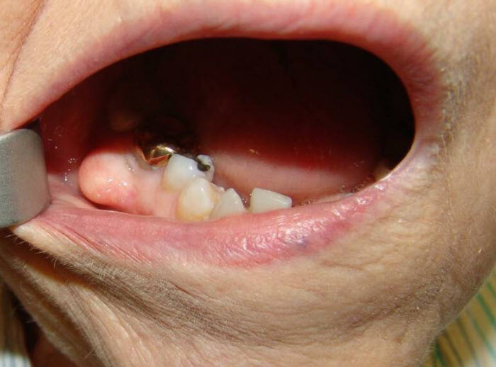 กระดูกงอก (TORI) ในช่องปาก-2