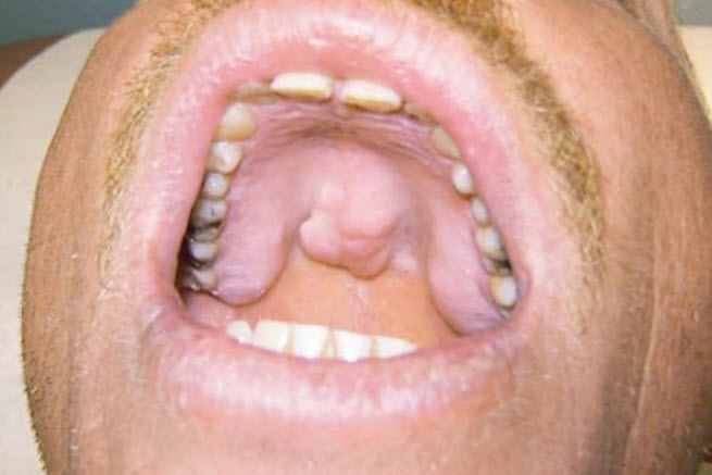 กระดูกงอก (TORI) ในช่องปาก-3