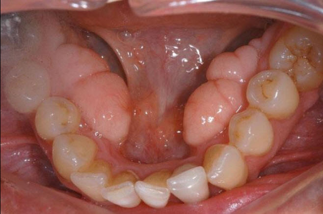 กระดูกงอก (TORI) ในช่องปาก-4
