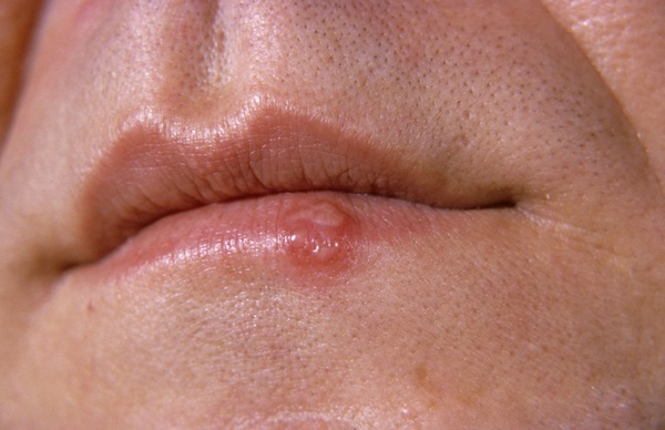 01 Oct 2007 --- Close up of a cold sore on a human lip caused by a Herpes simplex viral infection. --- Image by © ScienceVU/Visuals Unlimited/Corbis