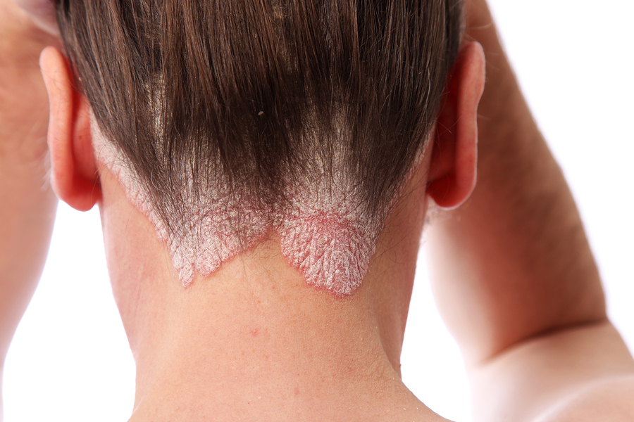 Psoriasis On The Hairline And On The Scalp