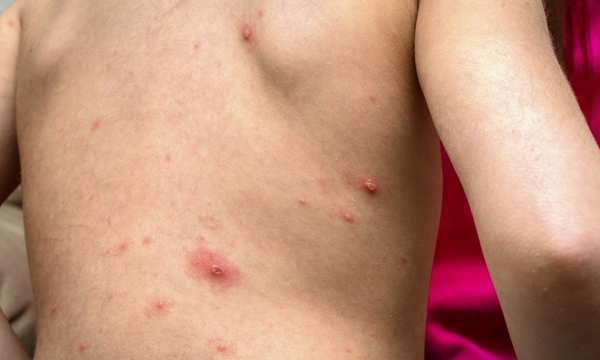 Varicella zoster virus or Chickenpox bubble rash on child, baby