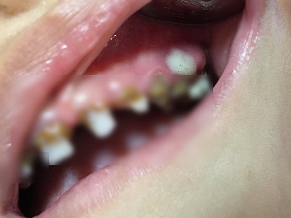 ฟัน-2